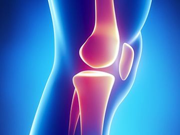 Knee Joint Replacement (Knee Arthroplasty)
