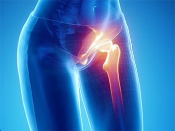 Hip Joint Replacement (Hip Arthroplasty)