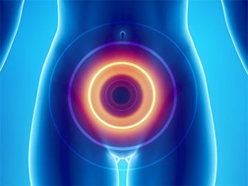 Cervical Cancer