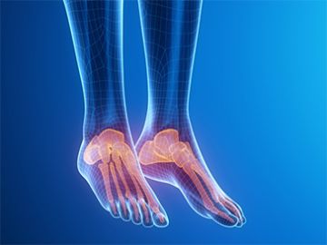 Hallux Valgus (Bunion Deformity)