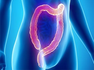Colitis