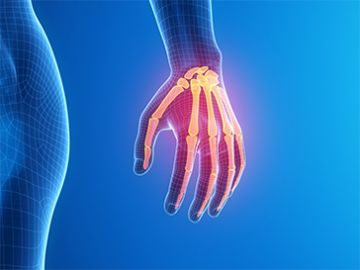 Wrist Joint Replacement