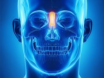 Deviated Nasal Septum