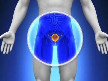 Prostate Cancer