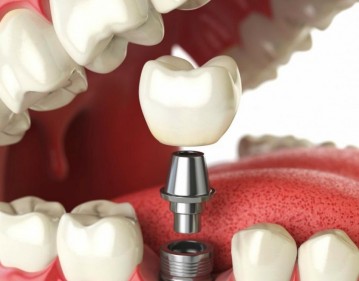 Dental Implants