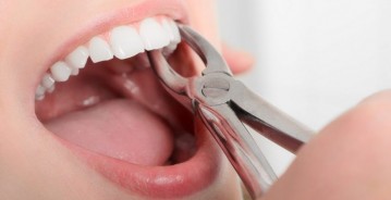 Tooth Extraction