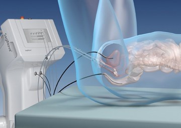 Brachytherapy