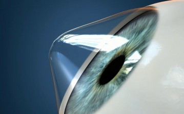 Keratoconus