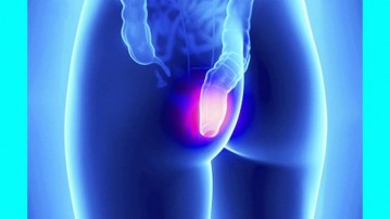 Hemorrhoids