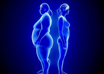 Bariatric Surgery