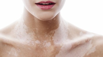 Vitiligo
