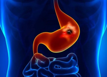 Gastritis