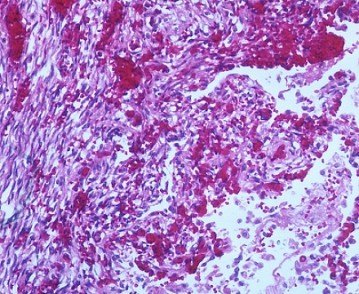 Ewing’s Sarcoma