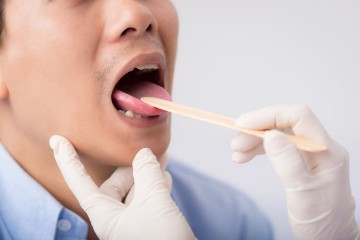 Tongue Cancer