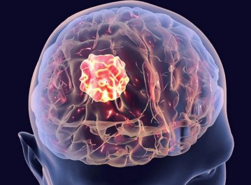 Glioblastoma