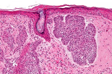 Carcinoma