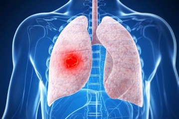 Lung Metastases
