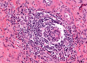 Sarcoidosis