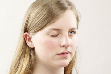 Myasthenia Gravis