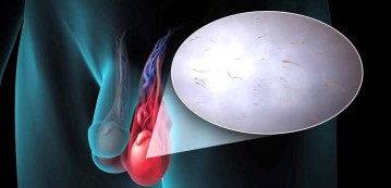 Varicocele