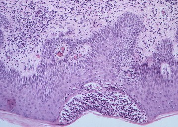 Pemphigus