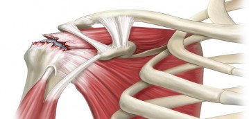 Shoulder Tendon Injury