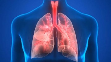 Pneumonia