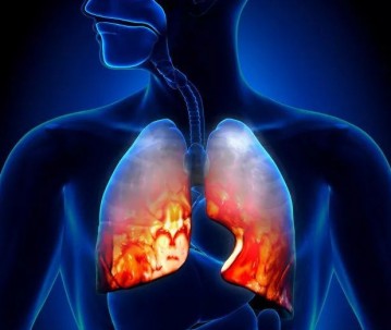 Respiratory Failure