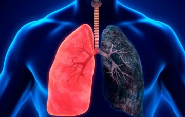 Chronic Obstructive Pulmonary Disease (COPD)