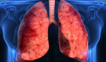 Cystic Fibrosis