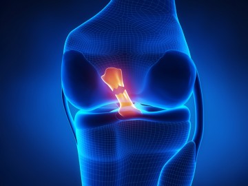 Knee Injury (ACL Tear)