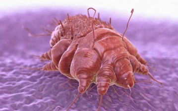Scabies