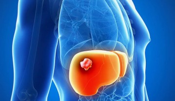 Liver Cyst