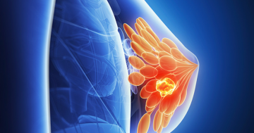 Breast Cyst