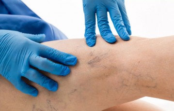 Varicose Veins