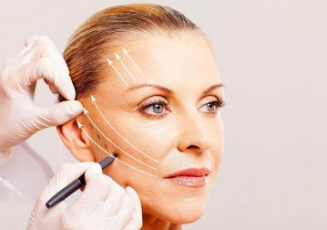 Deep SMAS Facelift