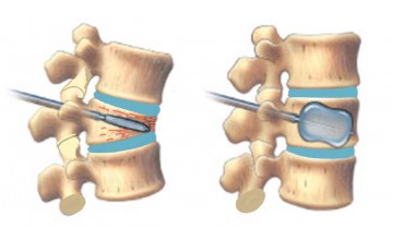 Kyphoplasty